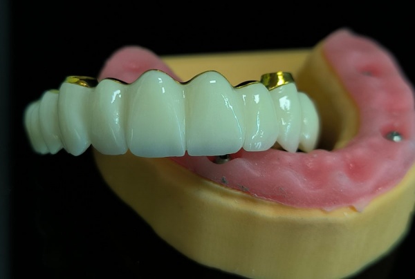 深圳義齒加工廠-義齒廠家-種植牙-全瓷牙-超薄貼面定制